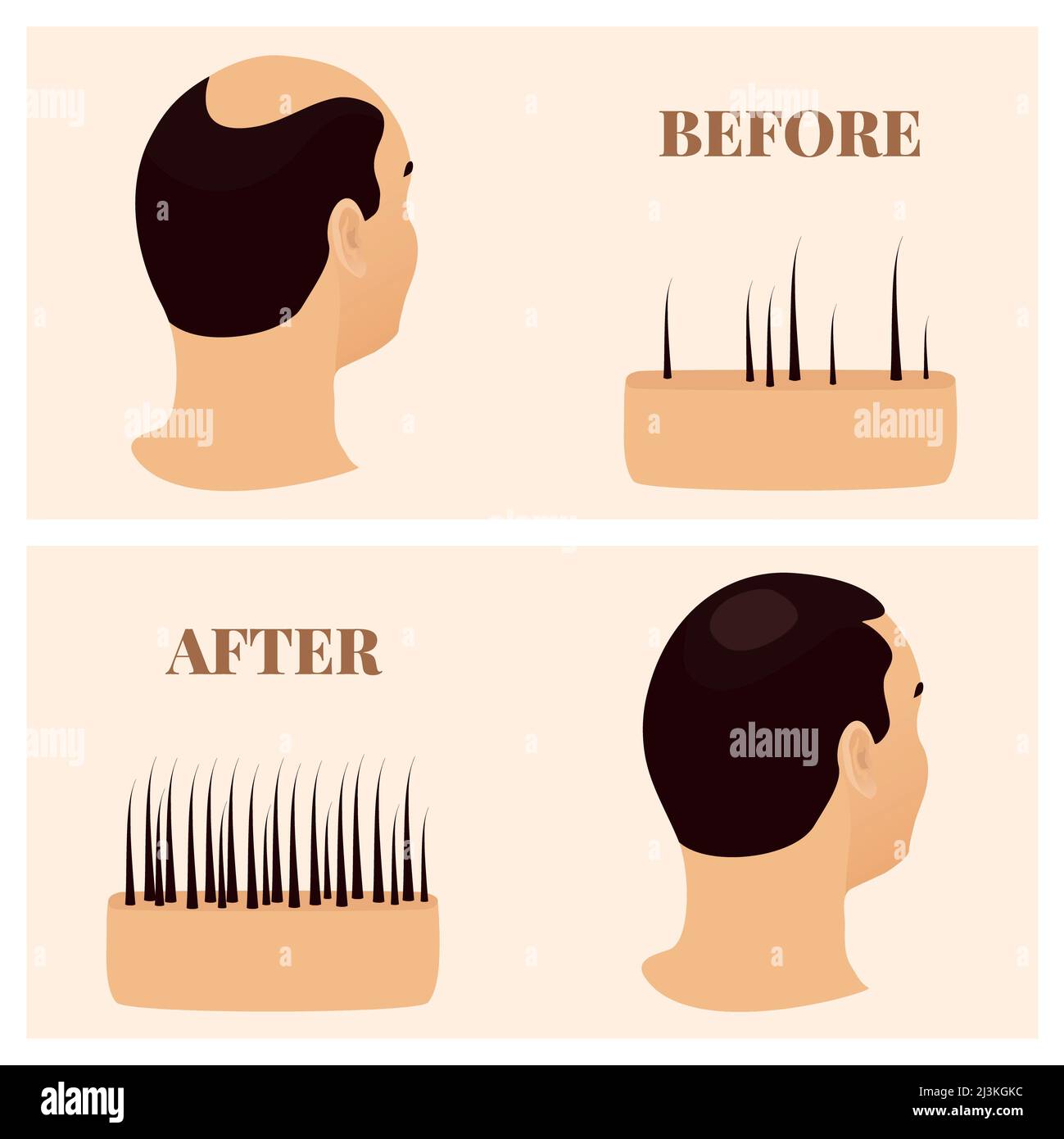 Hair loss treatment, conceptual illustration Stock Photo - Alamy