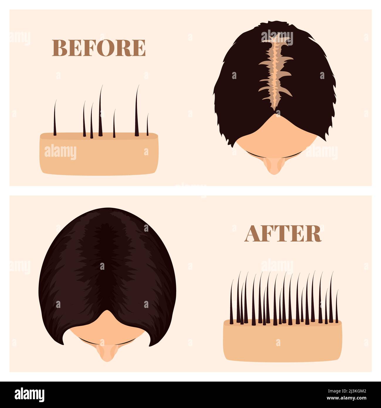 Hair loss treatment, conceptual illustration Stock Photo