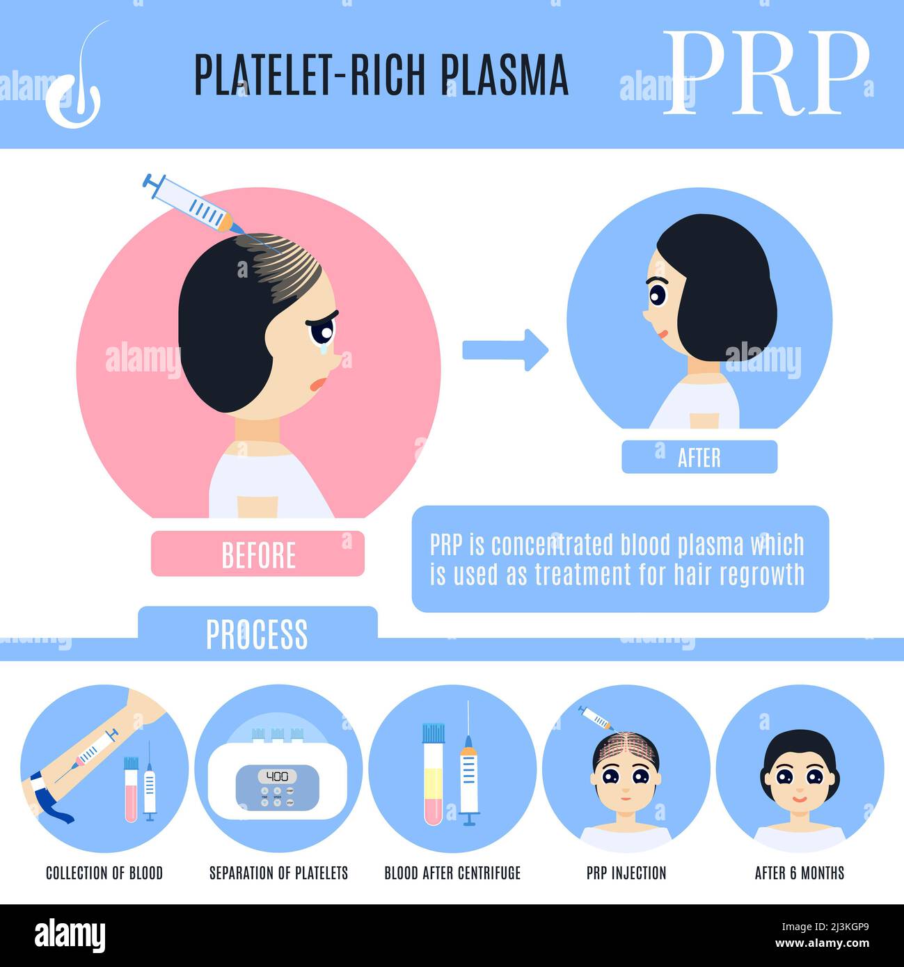 PRP hair loss treatment in women, illustration Stock Photo