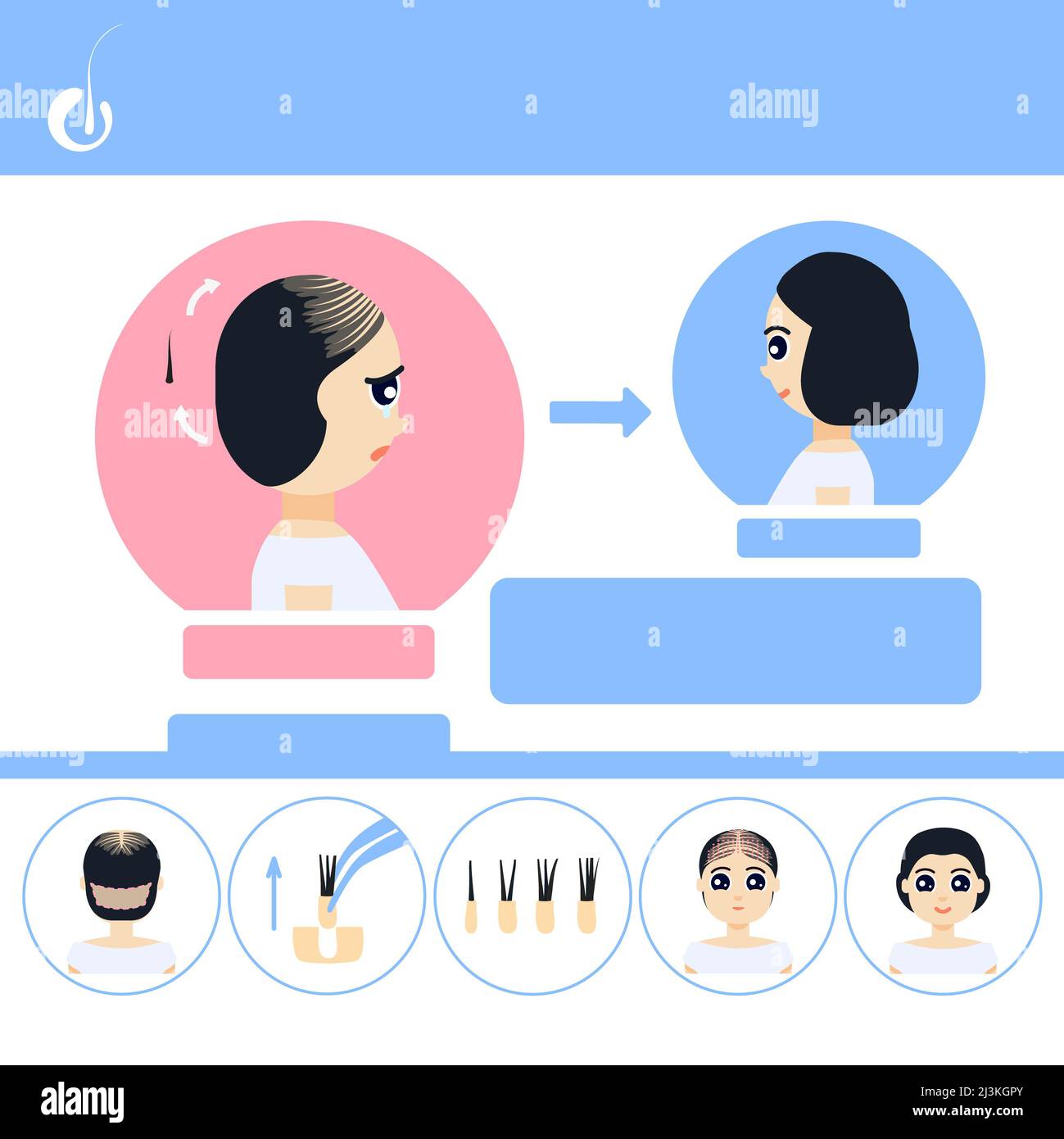 FUE hair transplantation in women, illustration Stock Photo