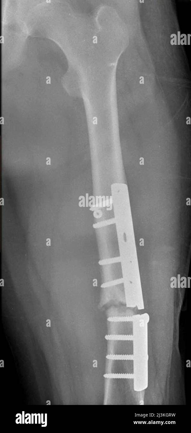 Femur fracture with broken plate, X-ray Stock Photo