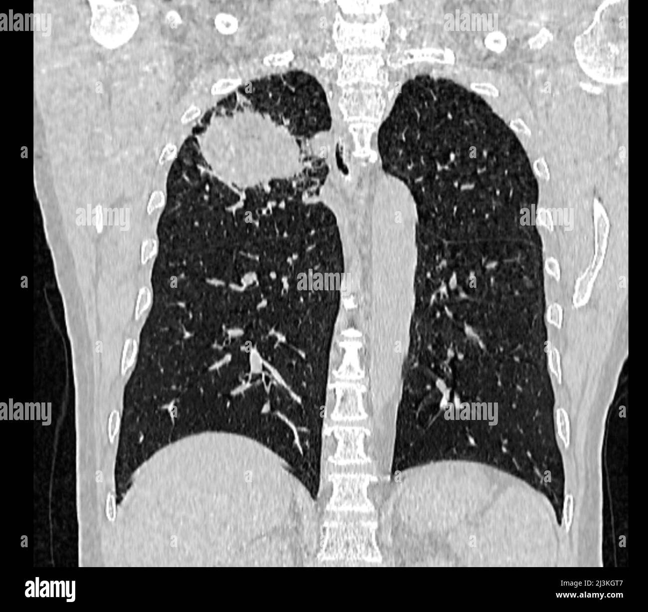 Lung carcinoma, CT scan Stock Photo