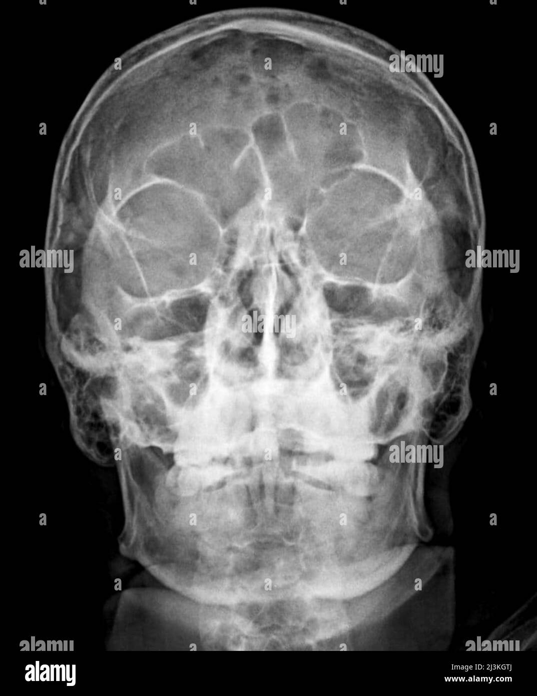 Myeloma x ray hi-res stock photography and images - Alamy