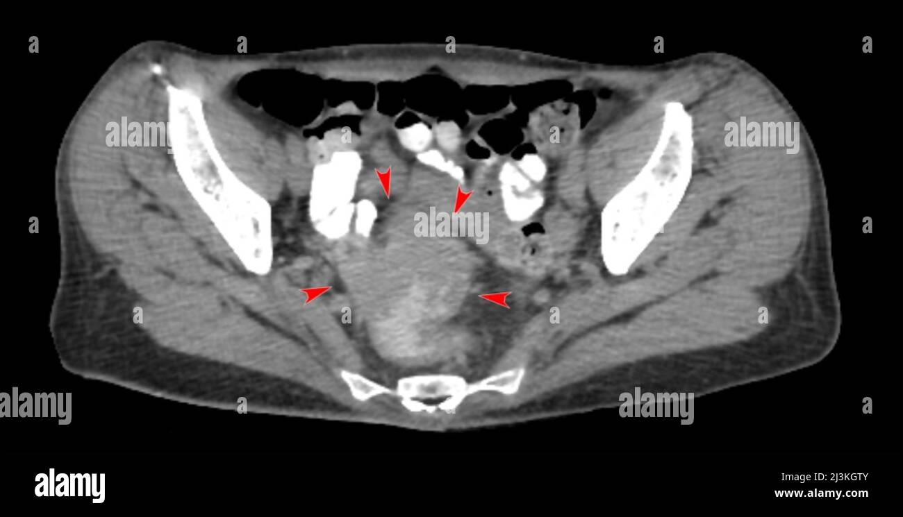 Colorectal cancer xray hi-res stock photography and images - Alamy