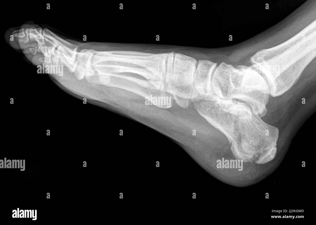 Calcaneal fractures hires stock photography and images Alamy