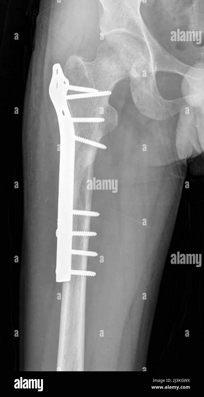 Pinned femur fracture, X-ray Stock Photo