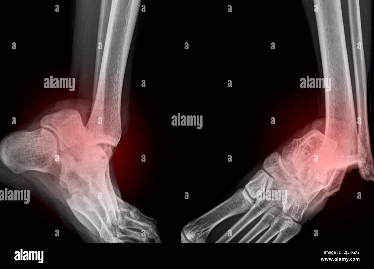 Dislocated ankle, X-ray Stock Photo