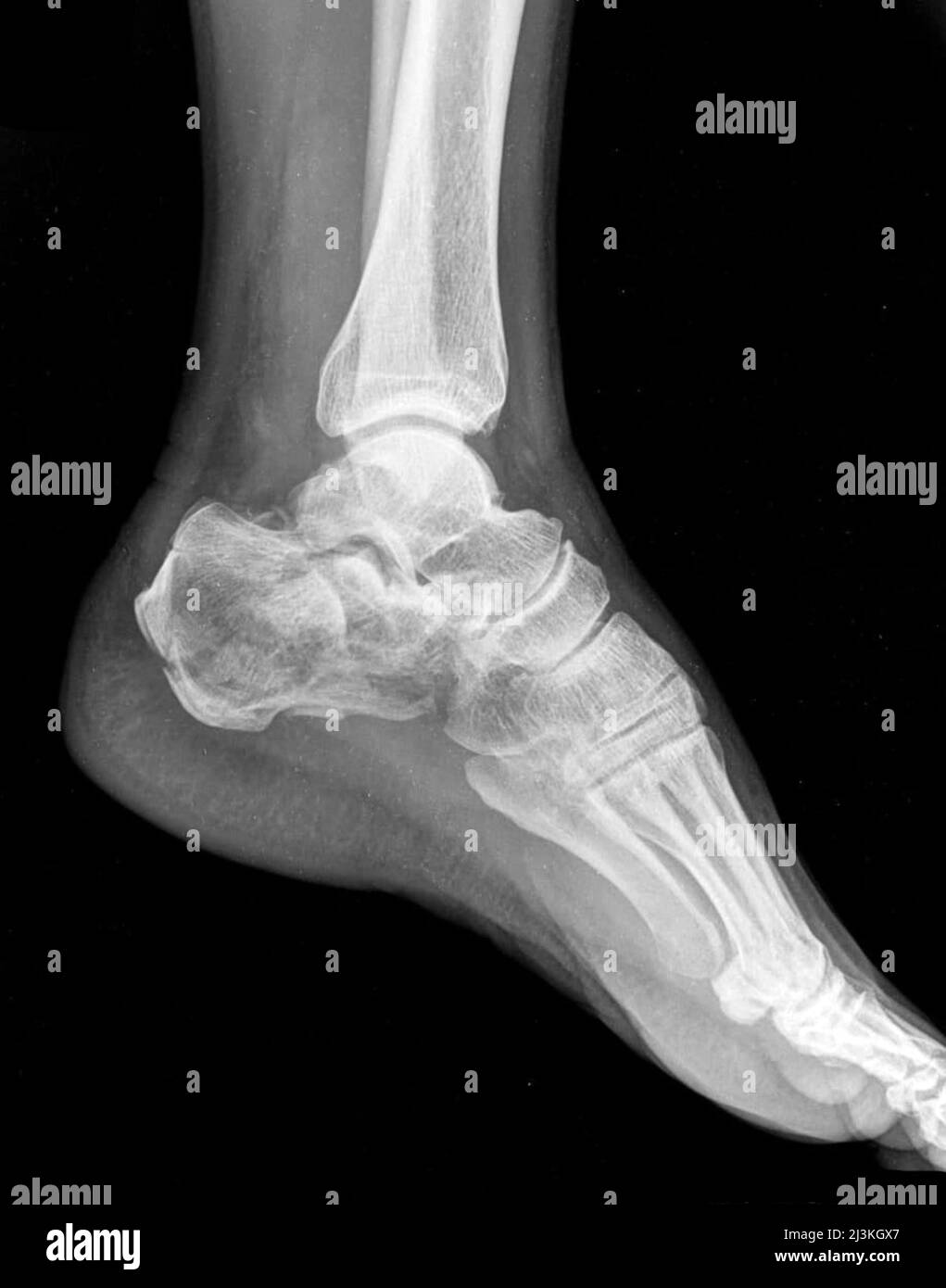 Heel bone fracture hires stock photography and images Alamy