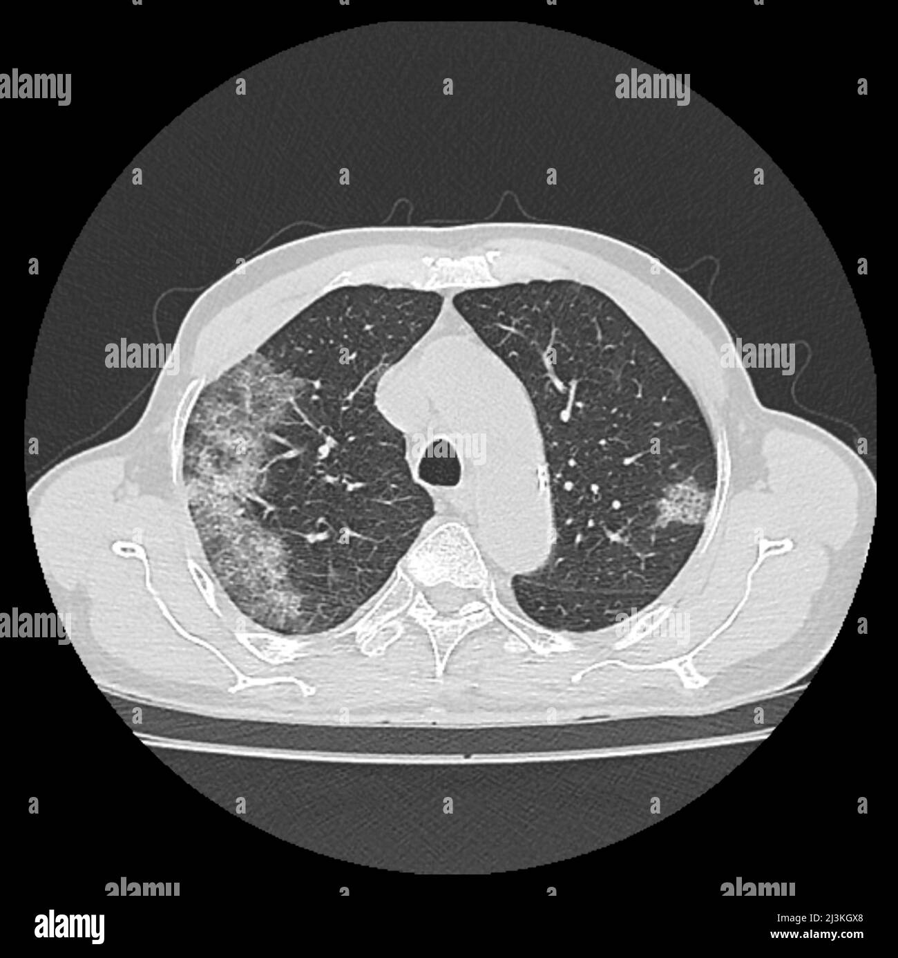 Covid-19 pneumonia, chest CT scan Stock Photo