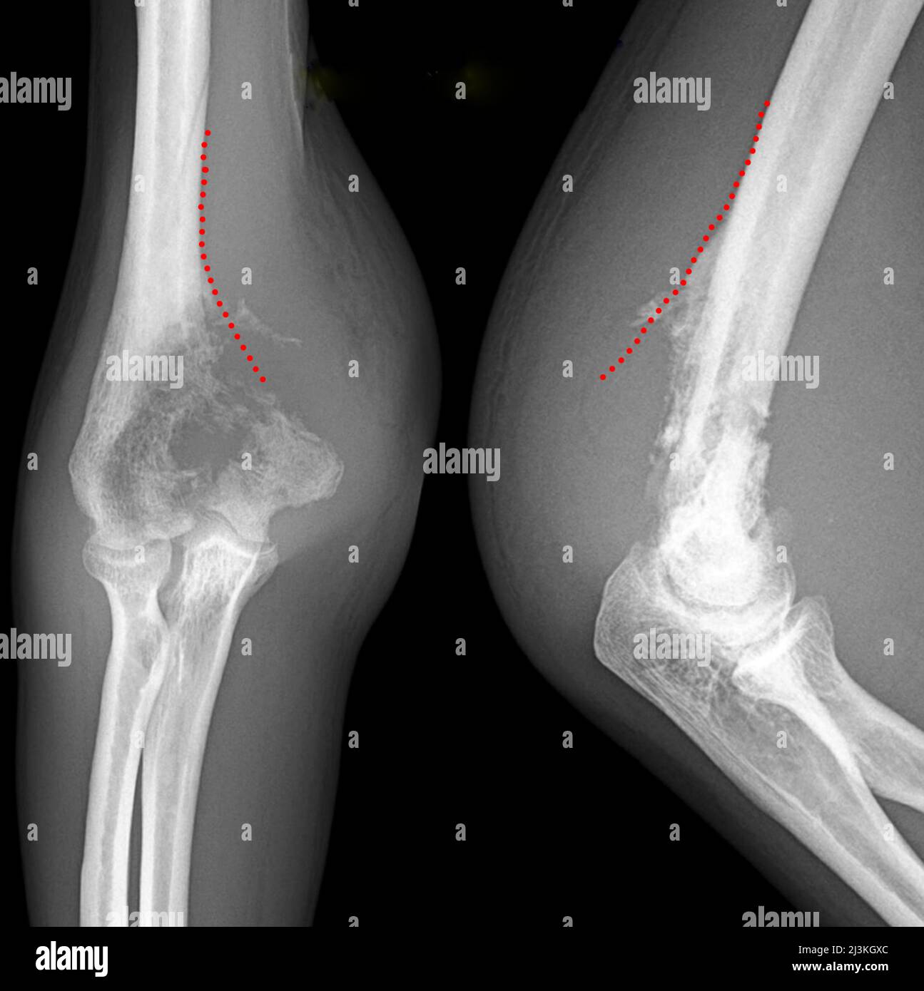Bone cancer of the elbow, X-ray Stock Photo