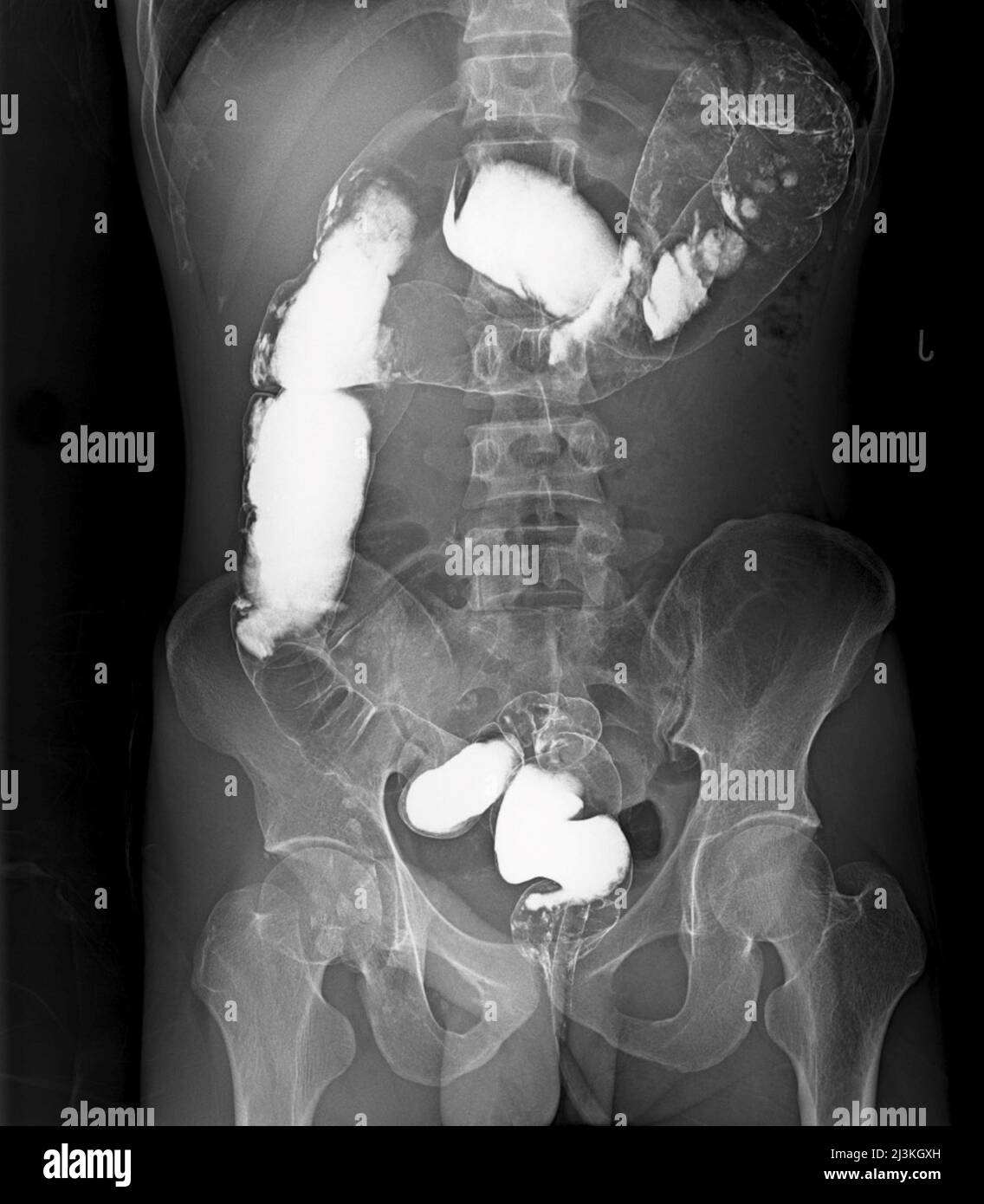 Reverse intestinal malrotation hires stock photography and images Alamy