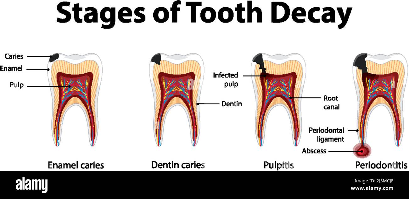 Infographic of human in the stages of tooth decay illustration Stock ...