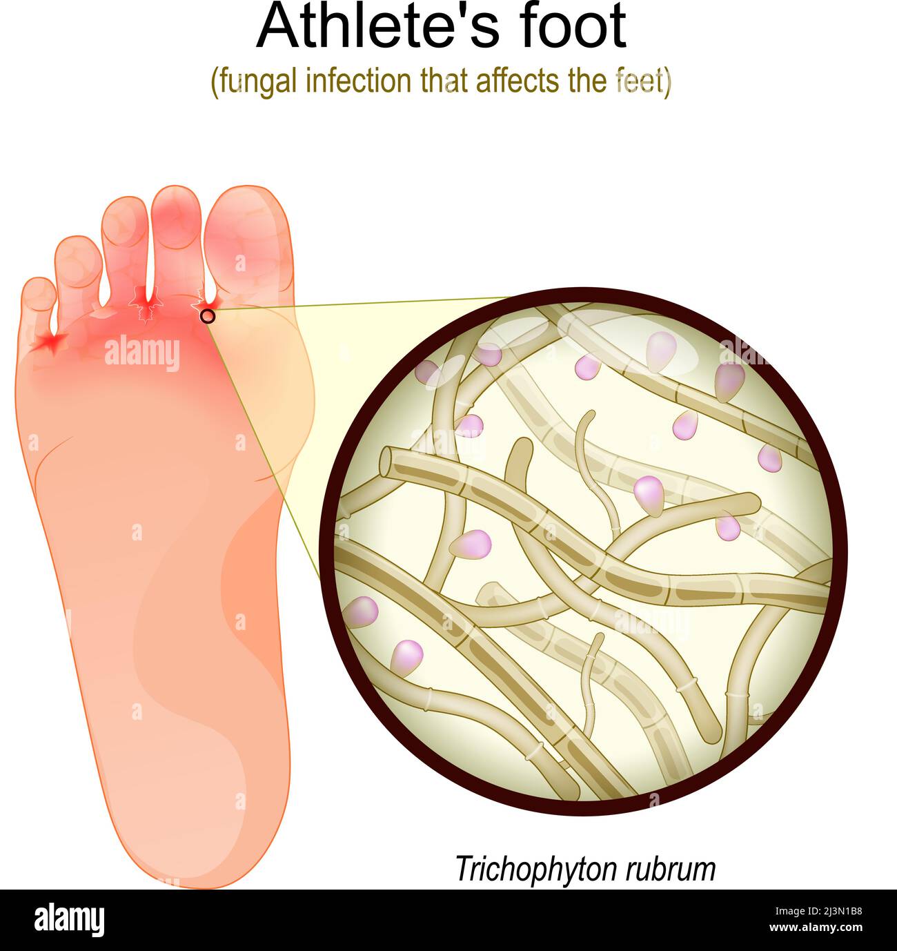 Athlete's foot is a fungal infection that affects the feet. sole of foot with parasitic fungus. Close-up of  Trichophyton rubrum Fertile Hyphae, Macro Stock Vector