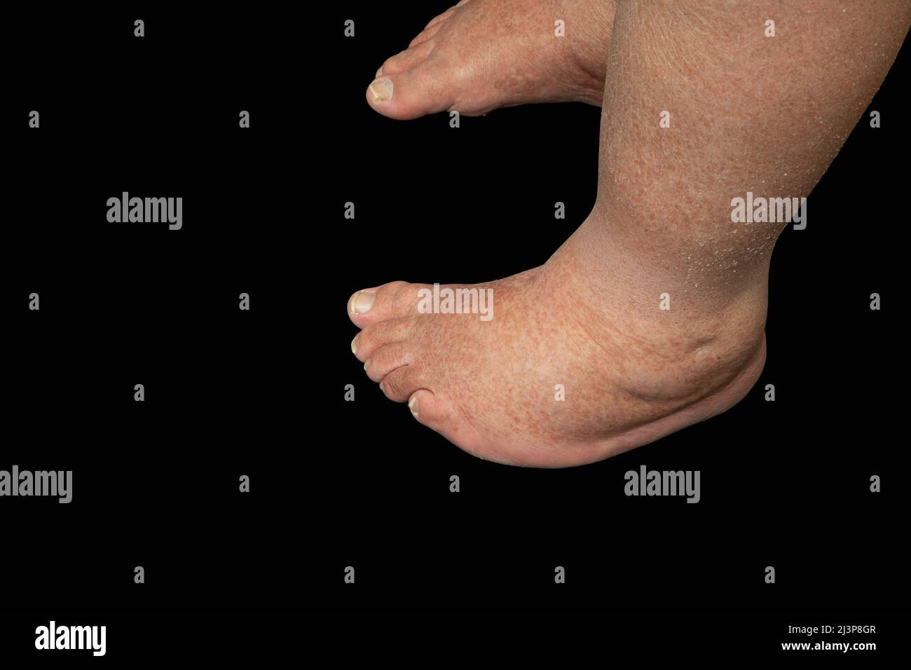 A man with clubfoot (talipes) standing on a black background. Both feet are turned inward because of the condition Stock Photo