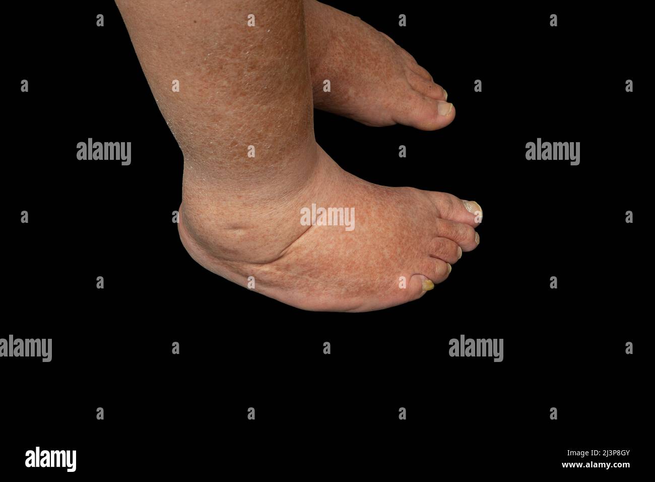 Talipes equinovarus hires stock photography and images Alamy