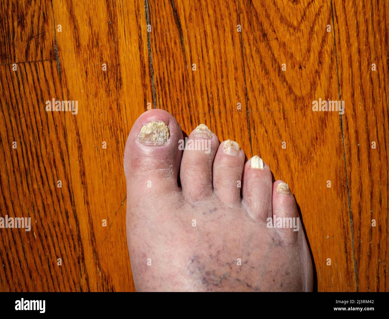 Fungal nail infections are common infections of the toenails that can
