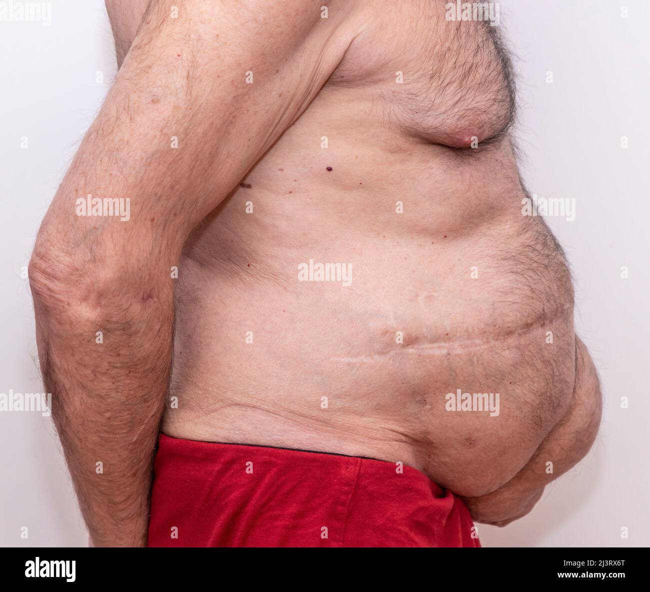 Side view of multiply abdominal incisional hernias Stock Photo