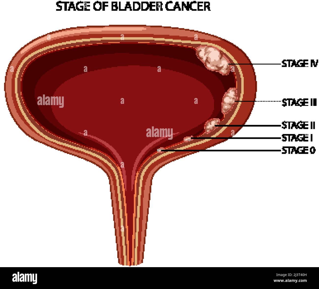 Stage Of Bladder Cancer Illustration Stock Vector Image & Art - Alamy