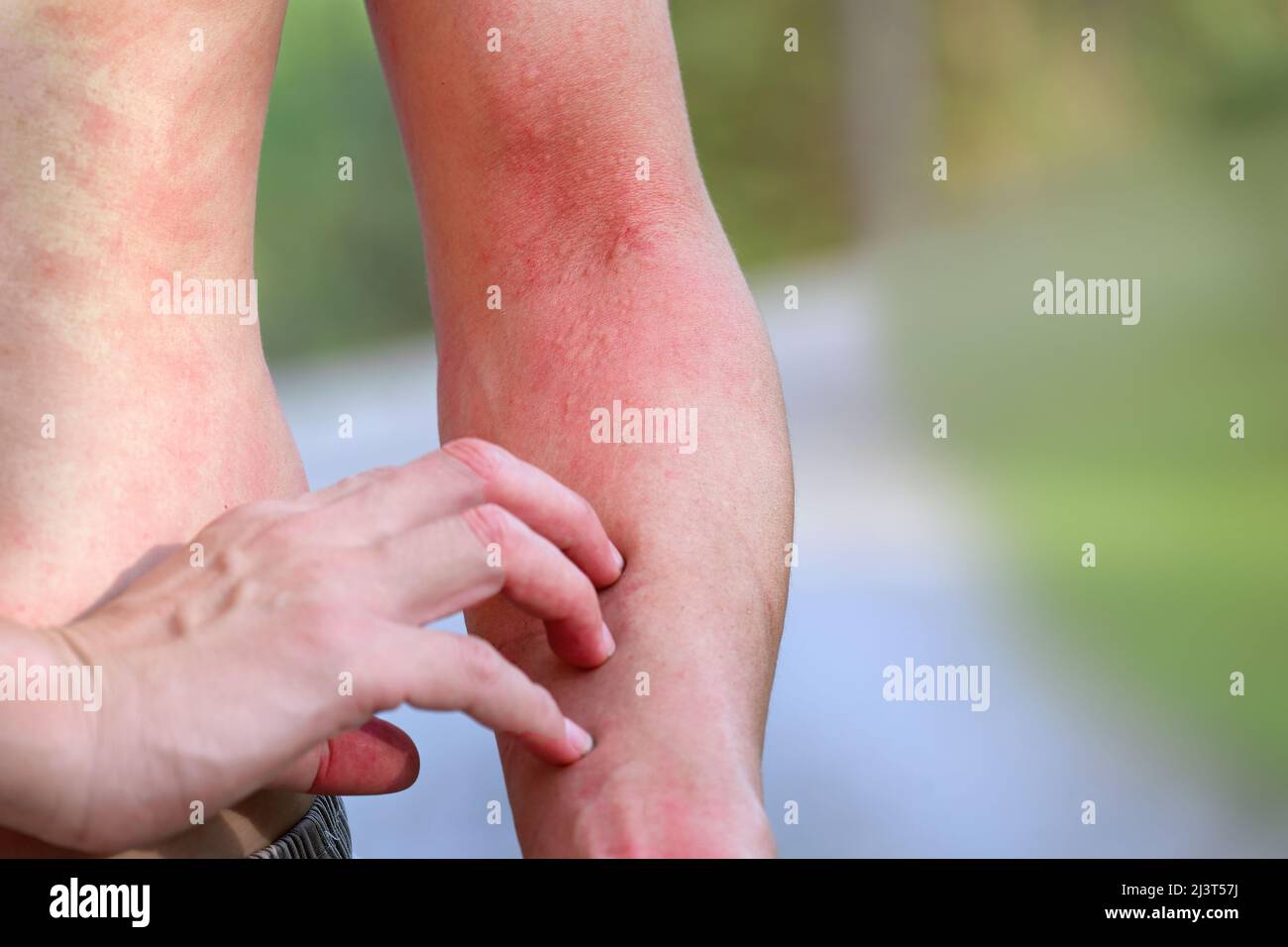 man suffering from itching on arm skin body and scratching an itchy place. Allergic reaction to allergic a caterpillar sting or insect bites Stock Photo