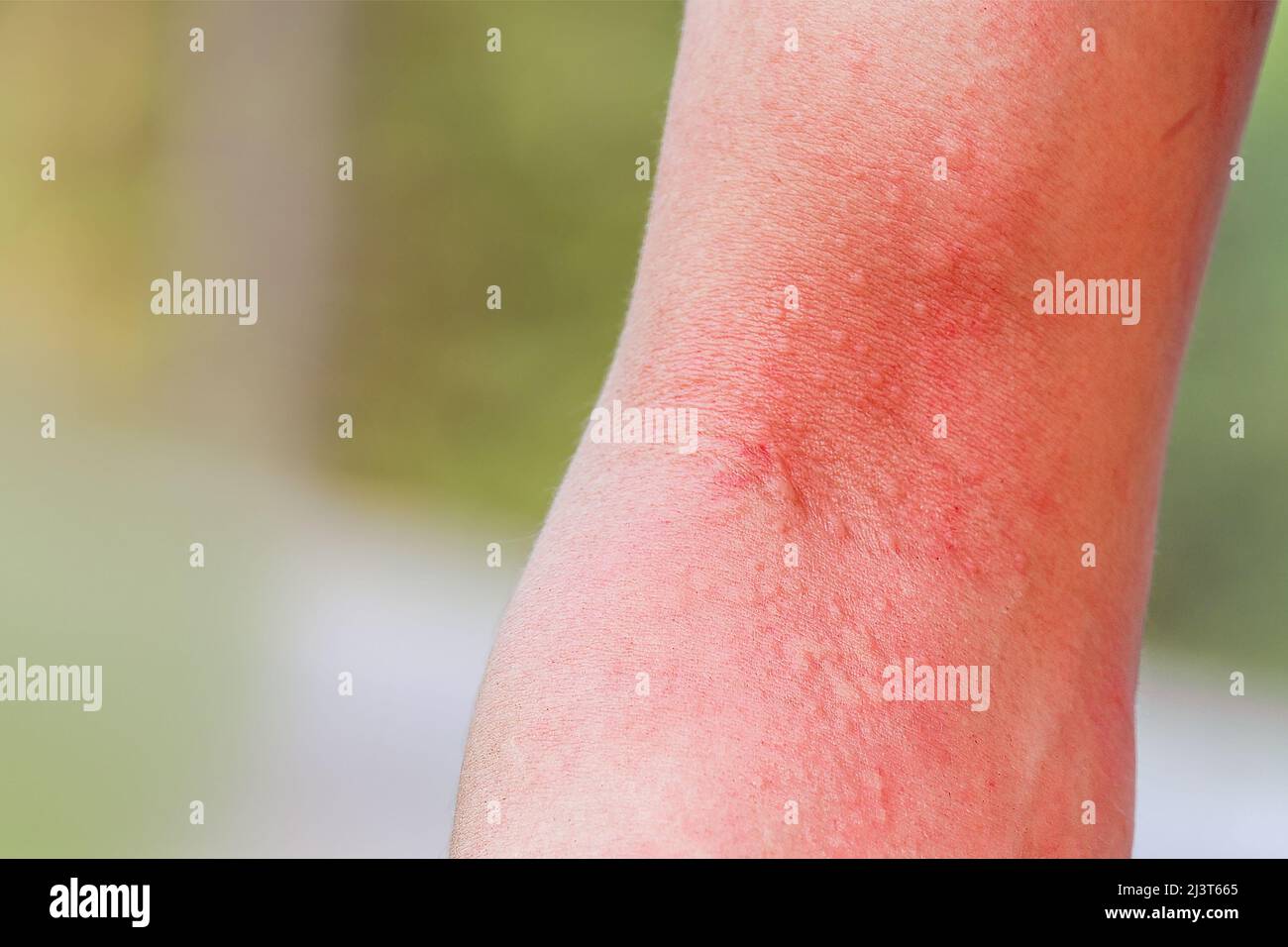 close up skin allergy itching on arm skin body allergic a caterpillar sting or insect bites dermatitis,Health care concept. Stock Photo