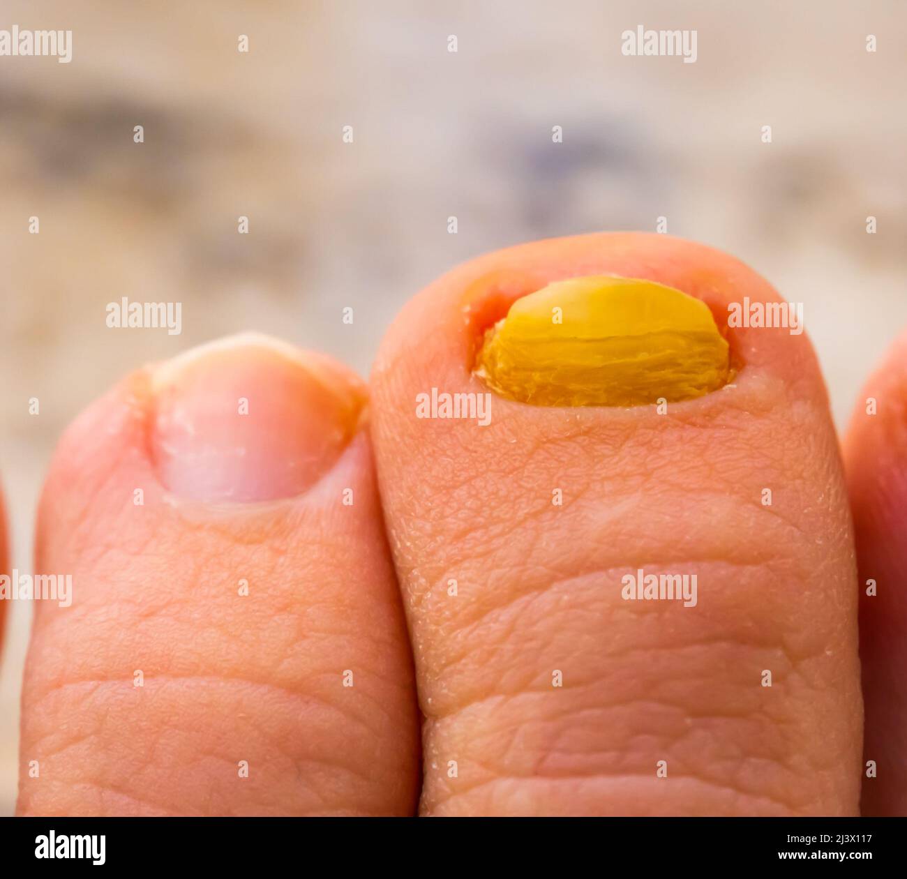 closeup of fungus infected nail compared to healthy nail, common disease and infections Stock Photo