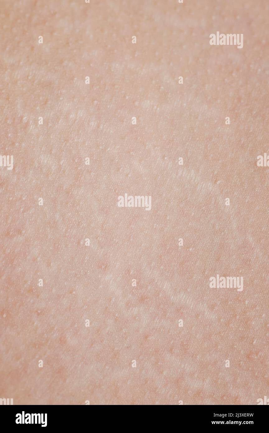 Stretch marks on human skin macro close up view Stock Photo
