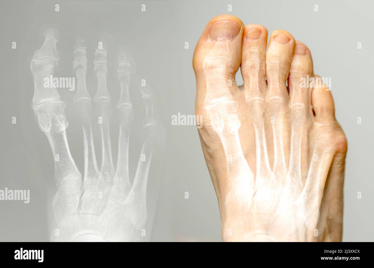 X-ray and the same foot. Hallux varus condition. Stock Photo