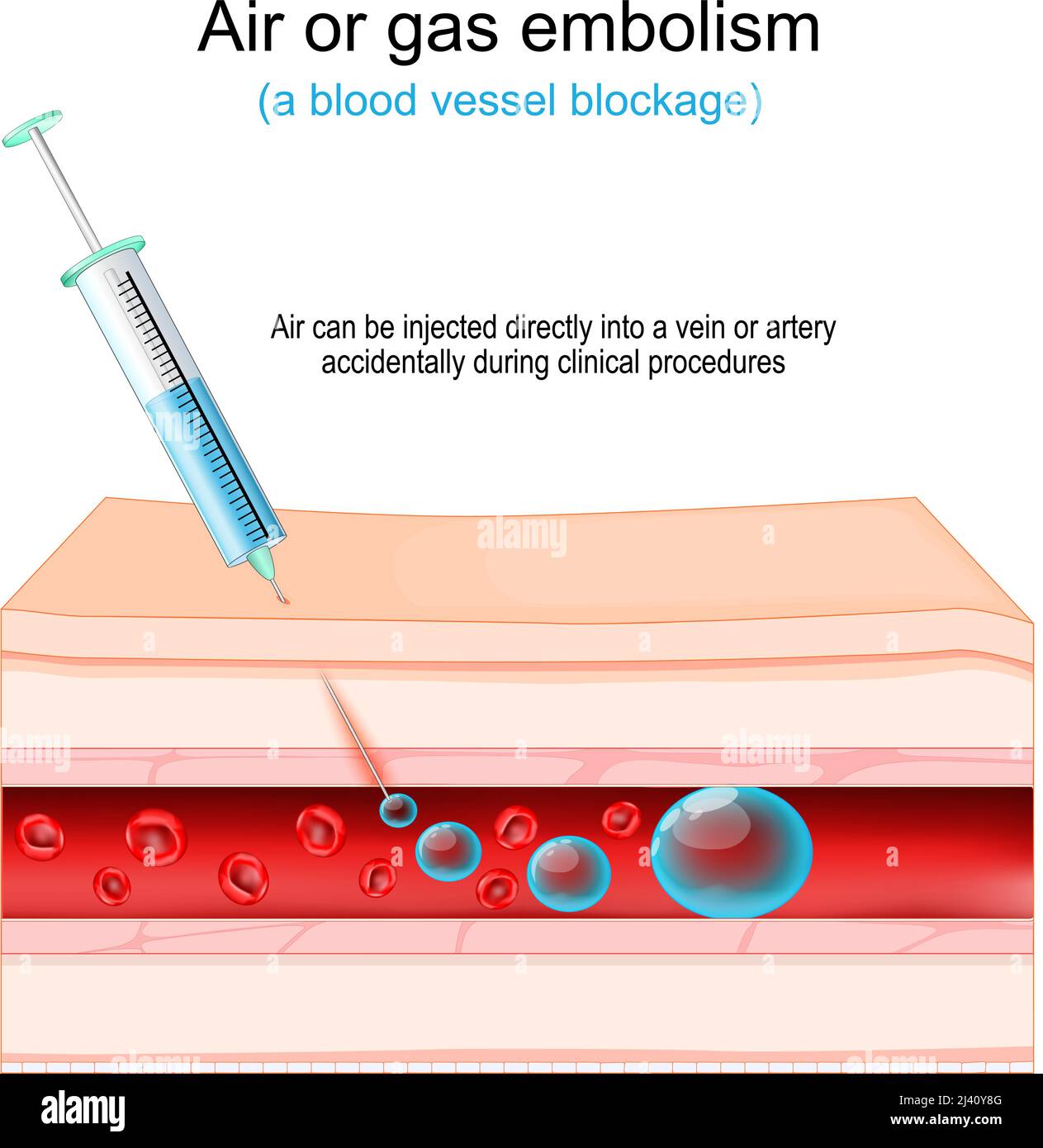 Air or gas embolism. blood vessel blockage. Air that injected directly into a vein or artery accidentally during clinical procedures. Human skin Stock Vector