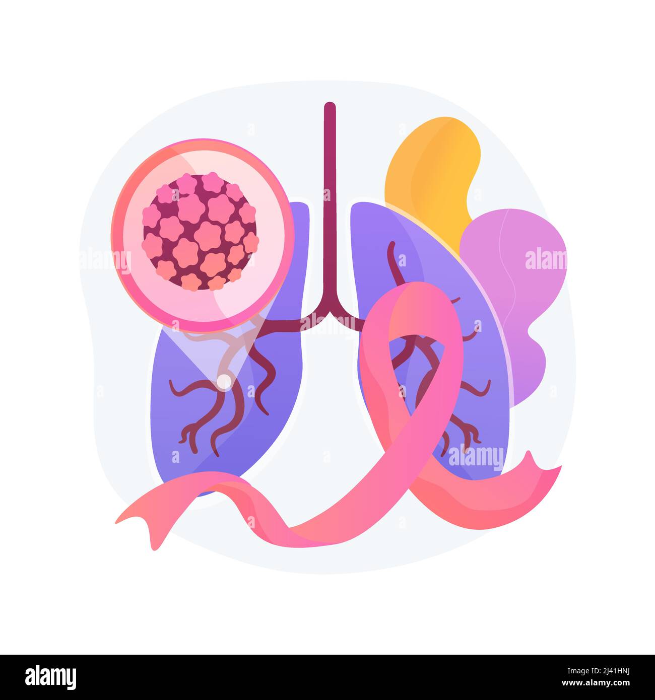 Lung cancer abstract concept vector illustration. Oncology early stage diagnostics, tumor risk factor, lung cancer treatment, fighting disease, chemic Stock Vector