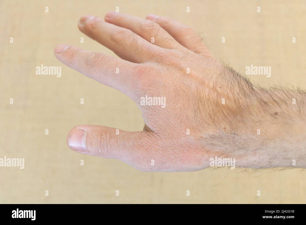 Chapped hand hi-res stock photography and images - Alamy