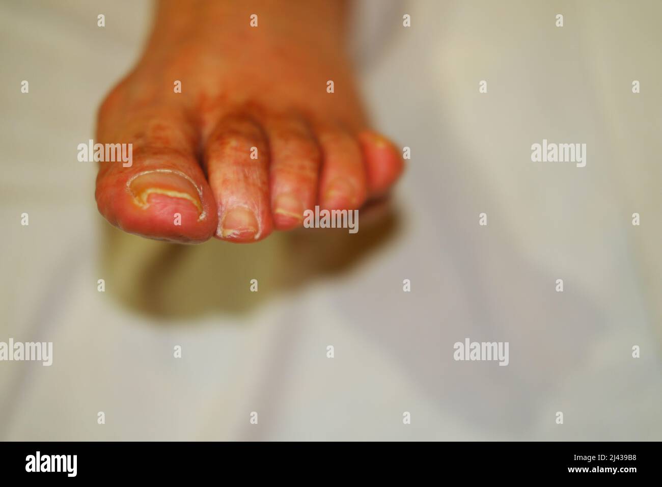 Ingrown toenail Stock Photo