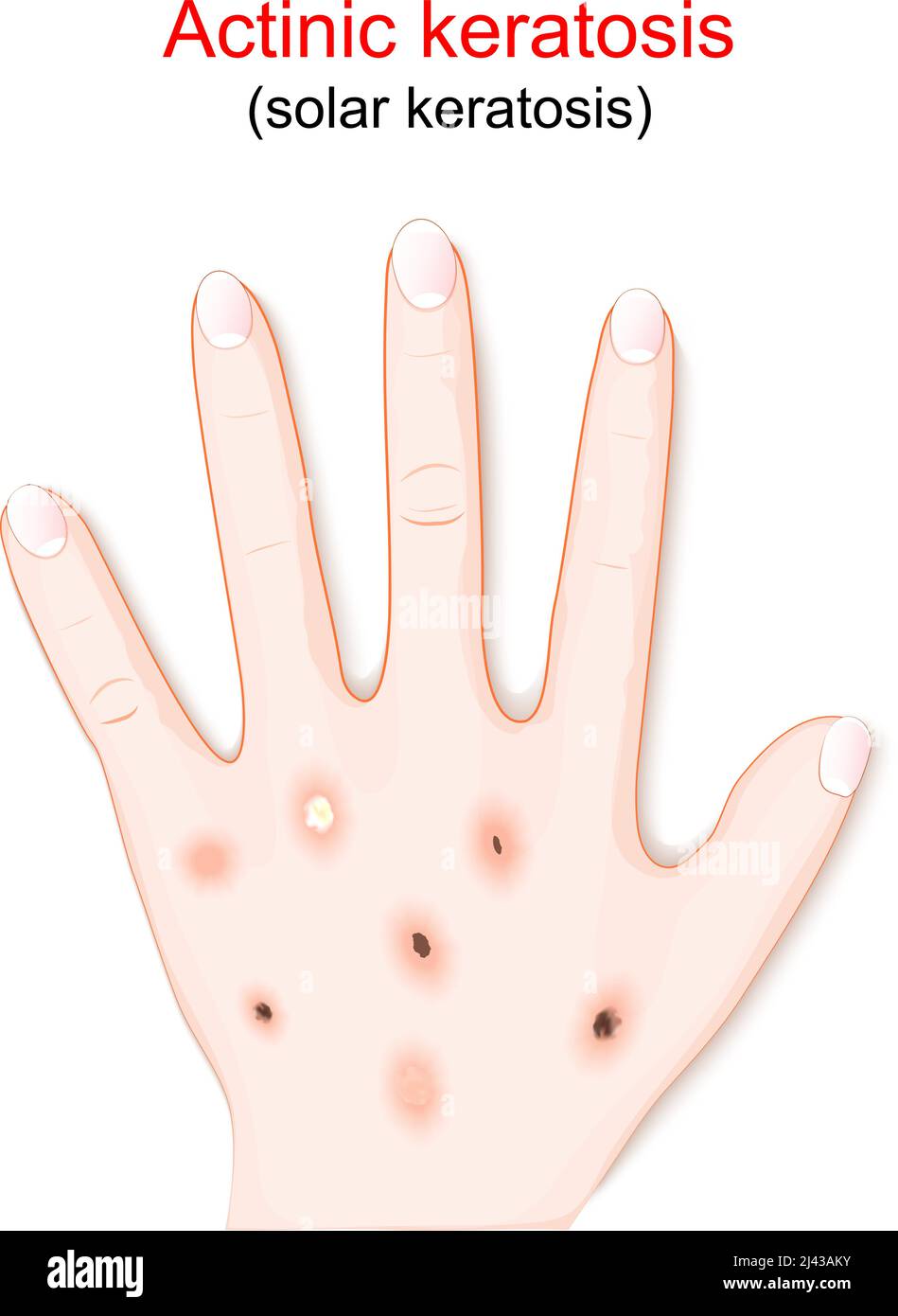 Actinic keratosis are dry scaly patches of skin that have been damaged by the sun. humans hand with solar keratosis. vector illustration Stock Vector