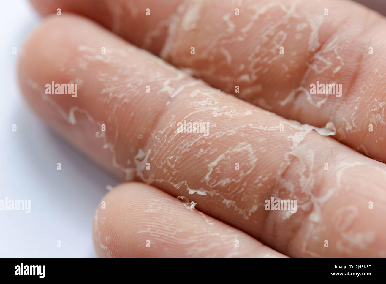 Peeling Skin on Hands: 12 Causes and Treatment Options