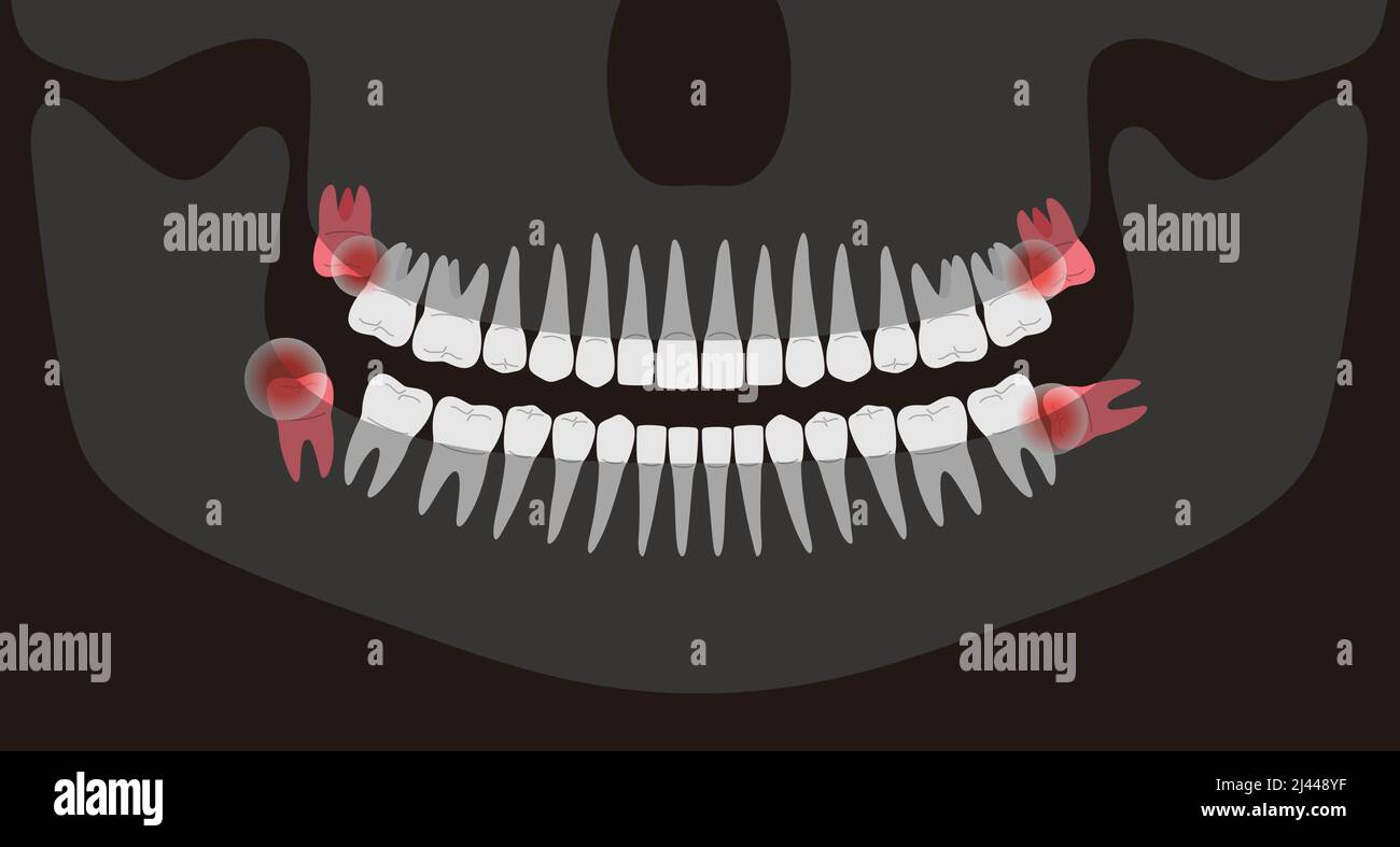 Human X-ray picture of teeth, vector illustration;, Inflamed teeth of human, It hurts in the mouth Stock Vector
