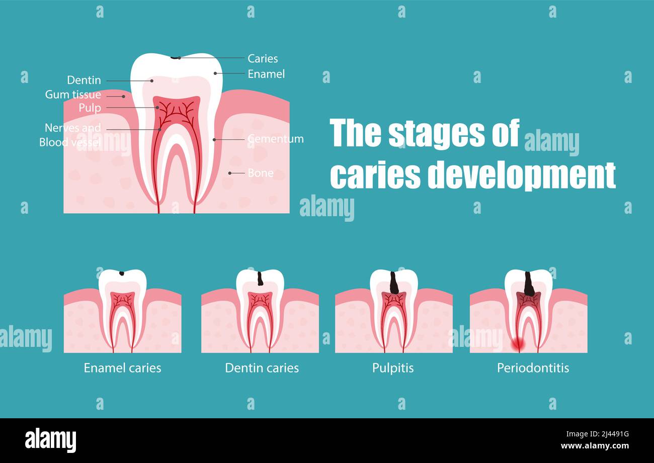 The stages of tooth decay, vector illustration Stock Vector