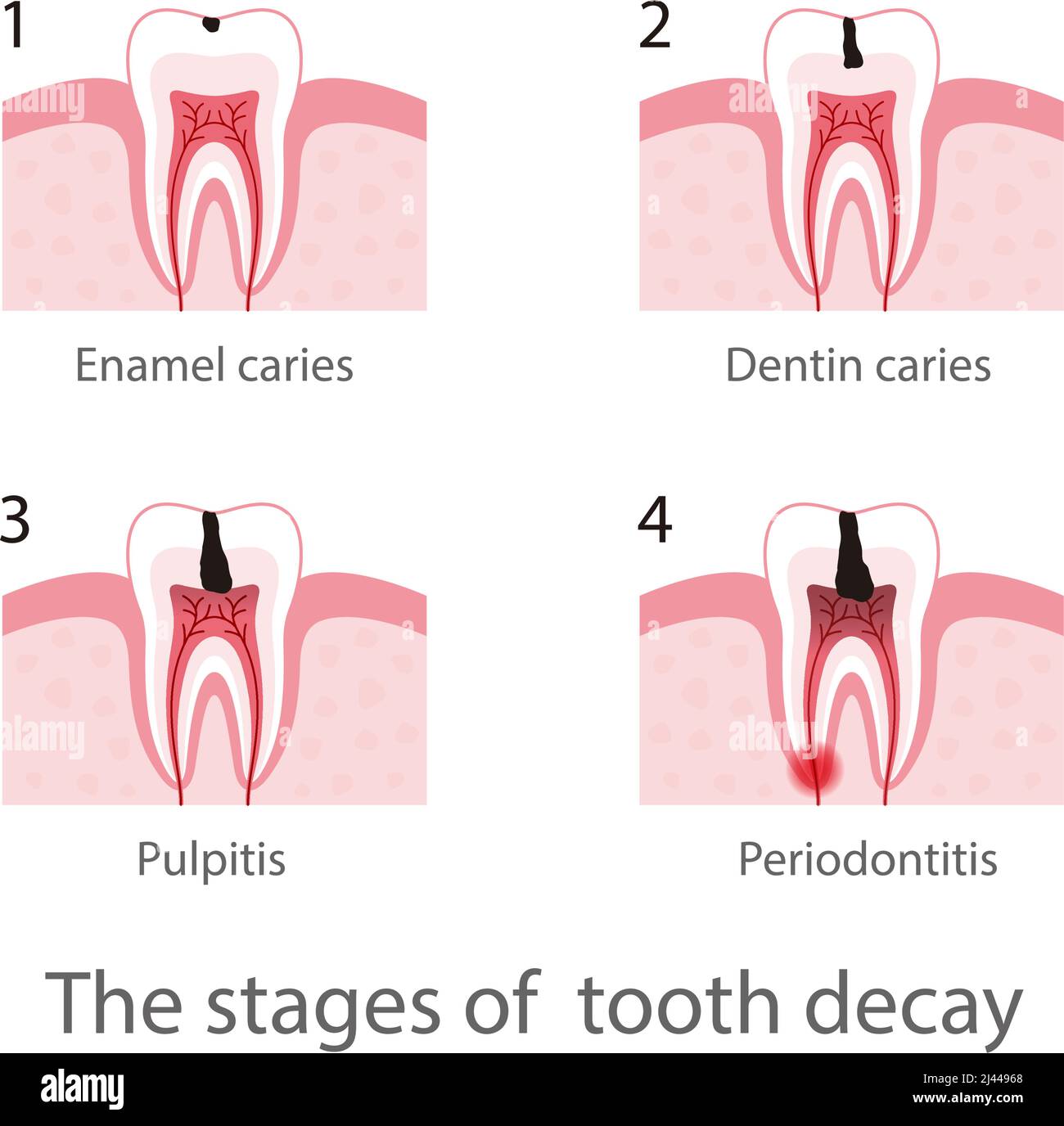 The stages of  tooth decay, vector illustration Stock Vector
