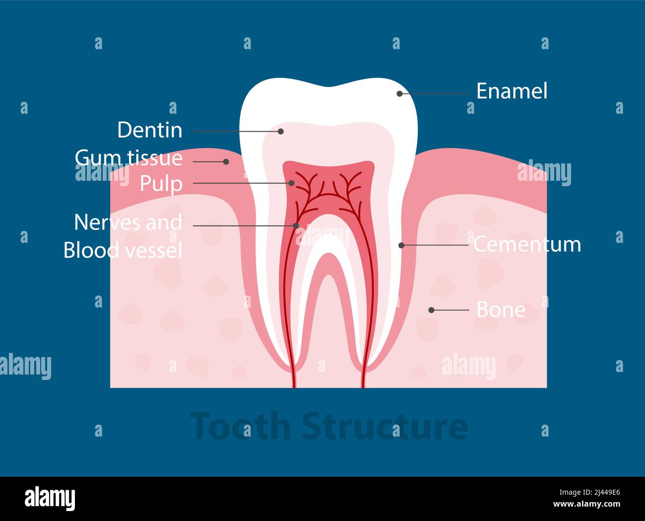 The stages of tooth decay, vector illustration Stock Vector