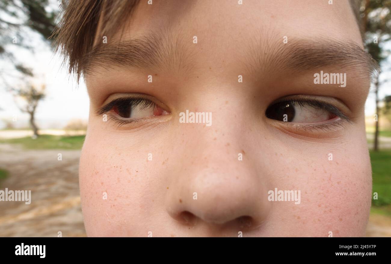 Close-up of the boy's face. The boy's eyes look away. Stock Photo