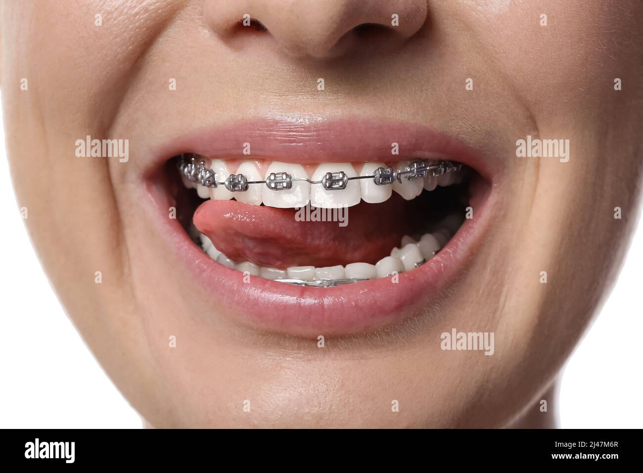 Woman with dental braces showing tongue on white background, closeup