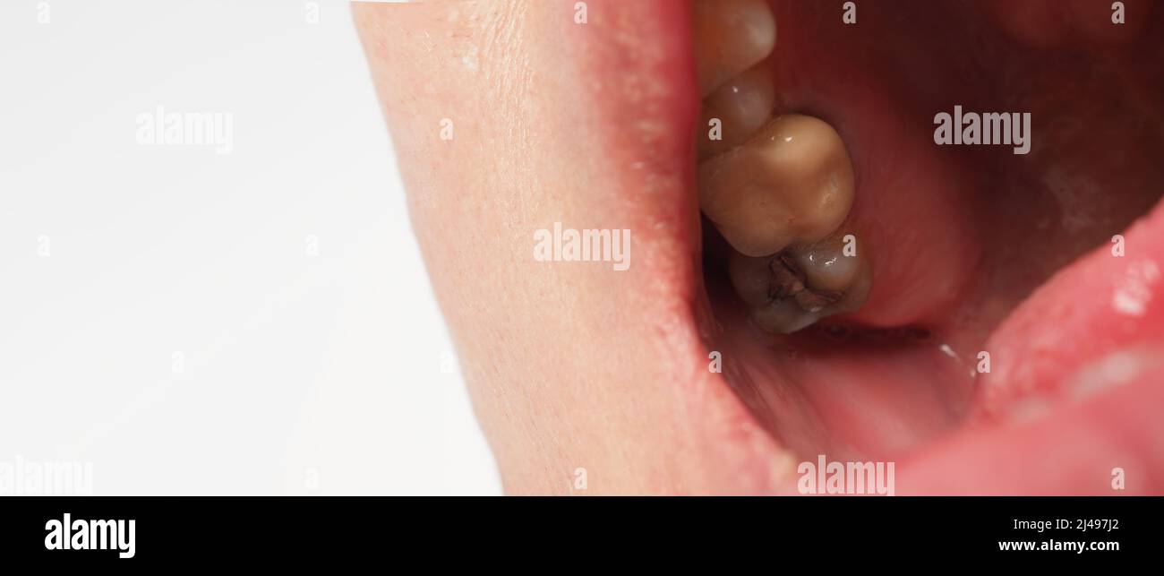 Decayed tooth root canal treatment. Tooth or teeth decay of lower molar ...