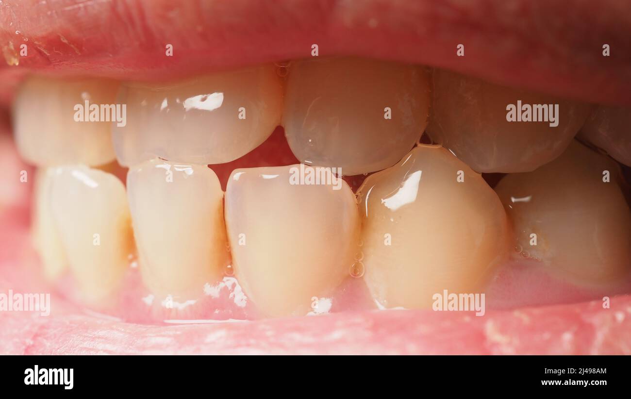 Decayed tooth root canal treatment. Tooth or teeth decay of lower molar