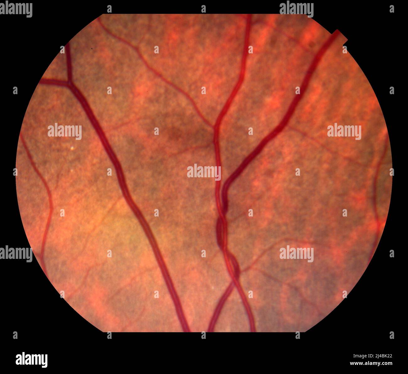 Arteriovenous nicking, fundoscopy Stock Photo Alamy