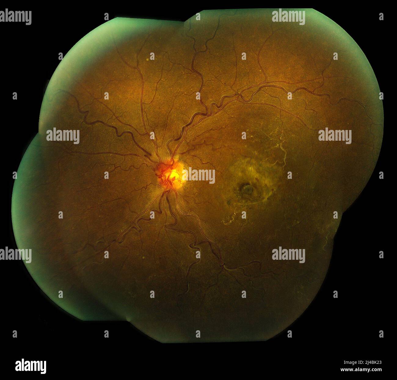 Central retinal vein occlusion Stock Photo - Alamy