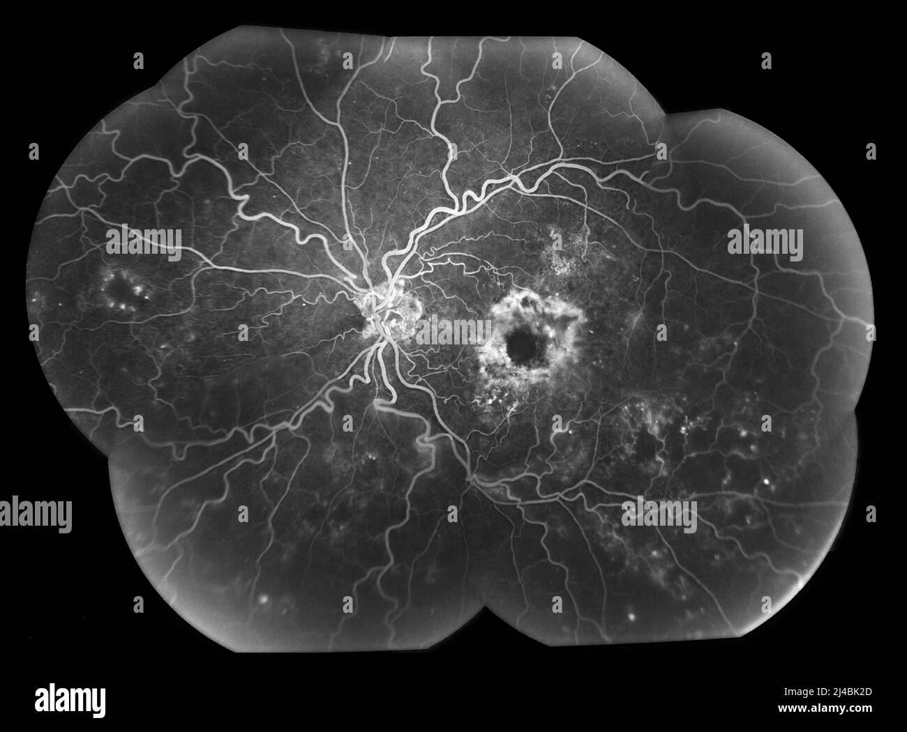 Central retinal vein occlusion, angiogram Stock Photo - Alamy