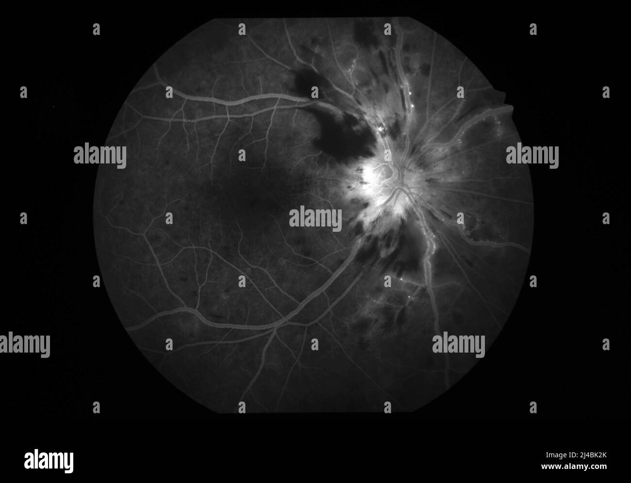 gabapentin optic neuropathy