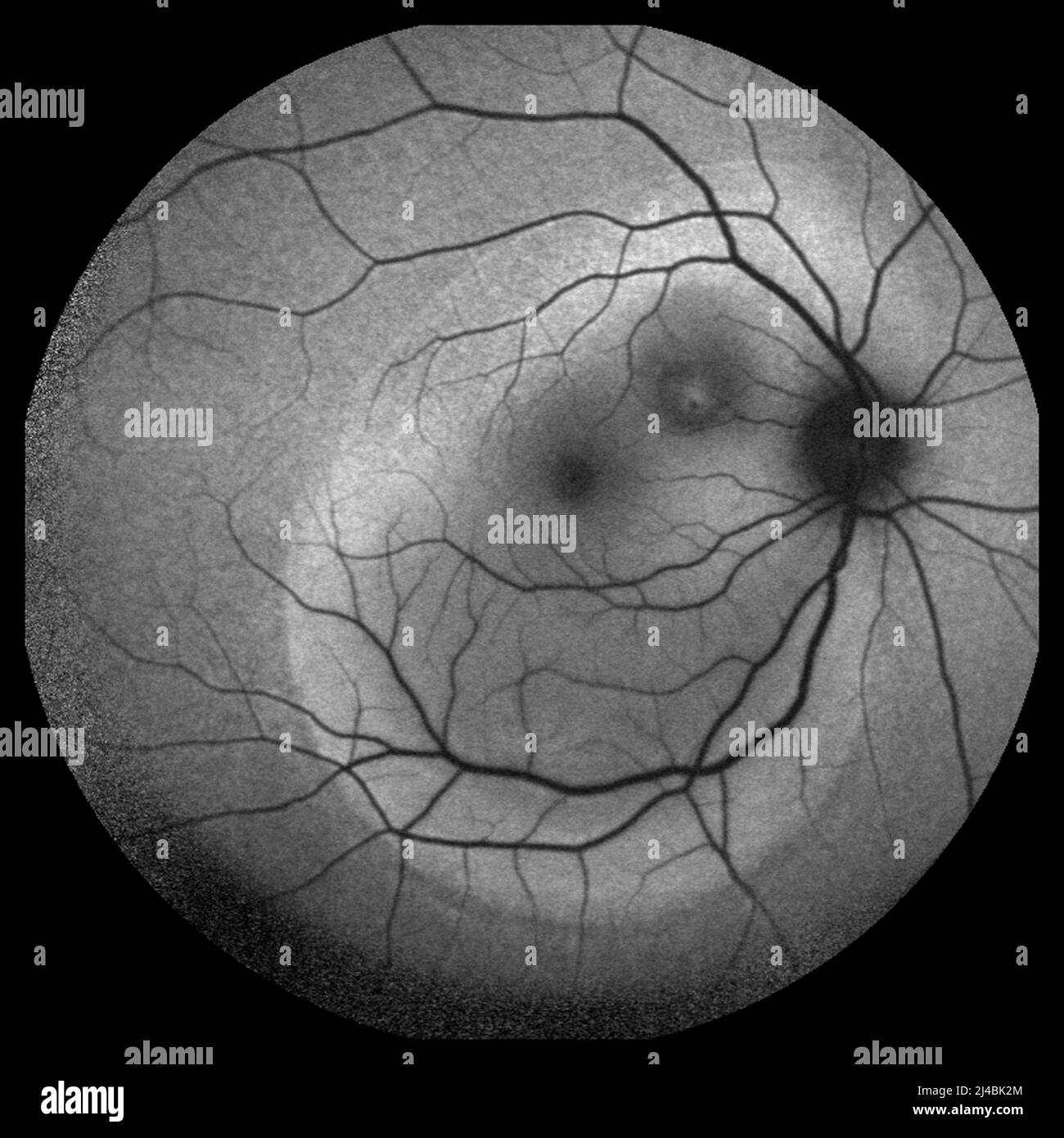 Central serous retinopathy, fundoscopy Stock Photo - Alamy