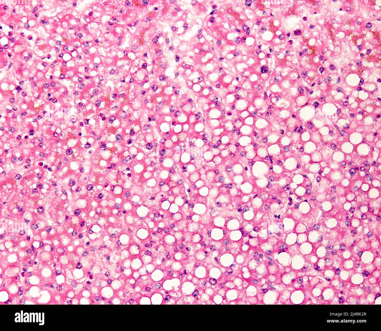 Fatty liver disease, light micrograph Stock Photo Alamy