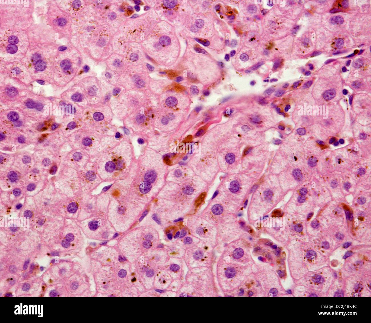 Cholestasis, light micrograph Stock Photo Alamy