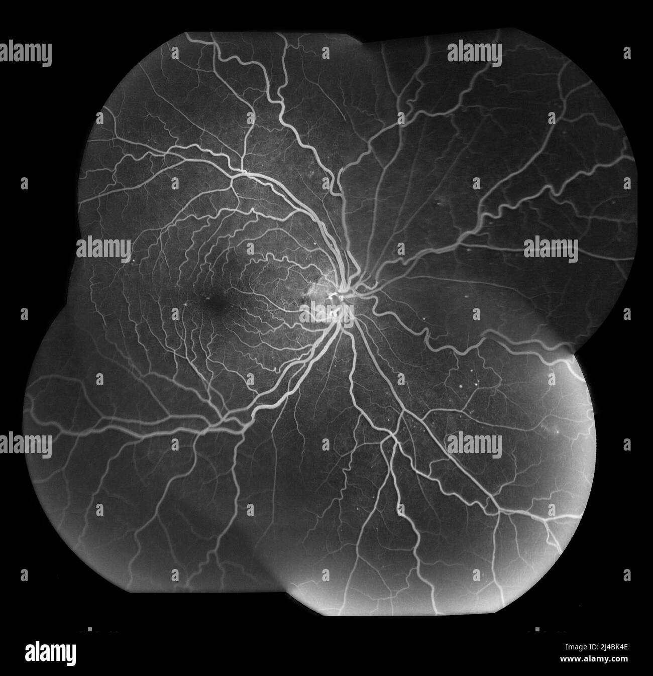 Central retinal vein occlusion, angiogram Stock Photo Alamy