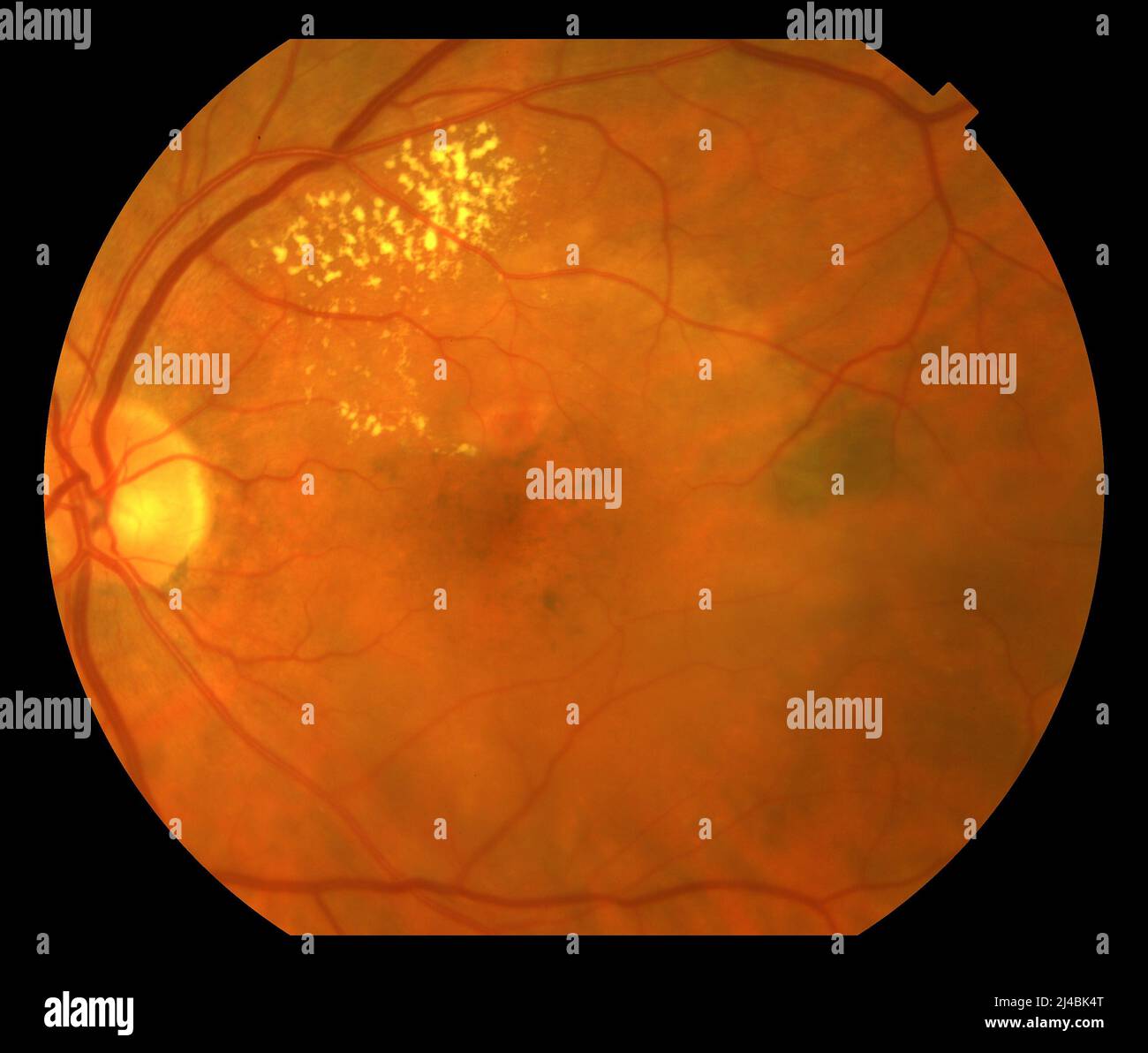Macular degeneration, funduscopy Stock Photo Alamy